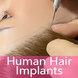 Human Hair Implants (-50% Off)